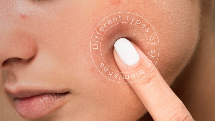 What type of blemishes do I have?