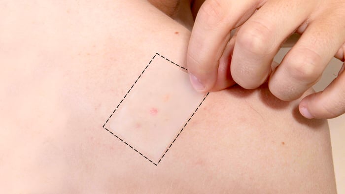 What is body acne and tips to treat it