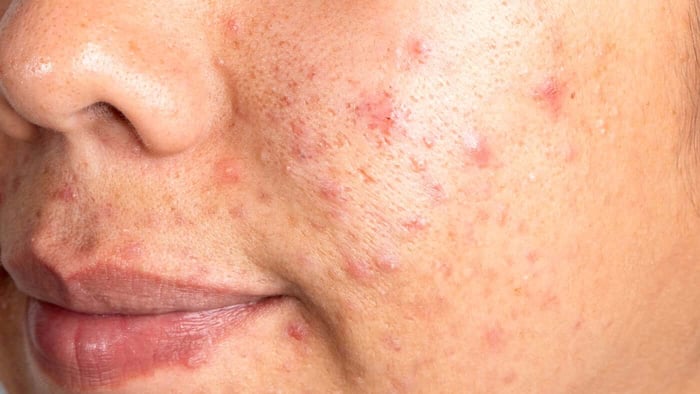 How Certain Lifestyle Habits Can Affect Your Skin