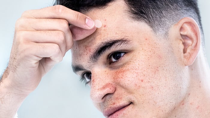 What to do once you’ve popped a pimple