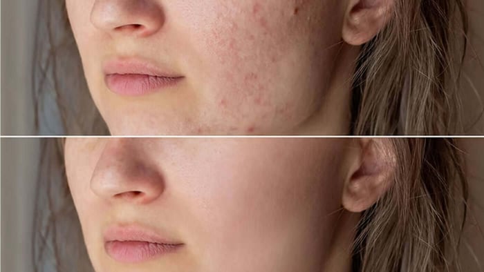 Root Causes of Skin Breakouts