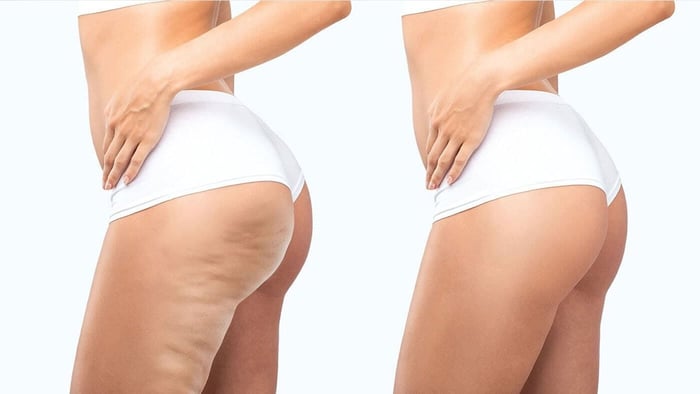 Why do some women get cellulite and others don’t?