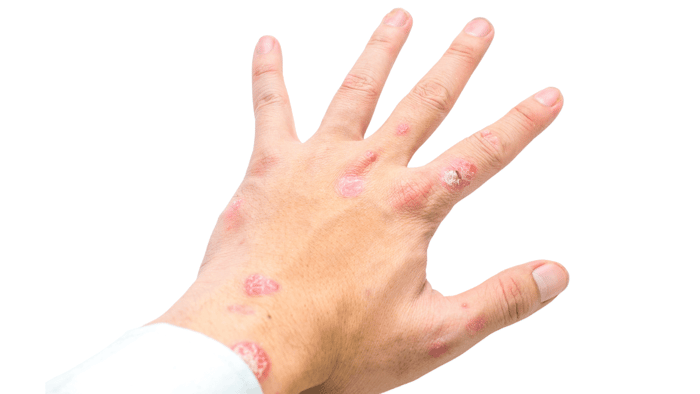 How Sea Moss Can Help Psoriasis: Understanding the Benefits