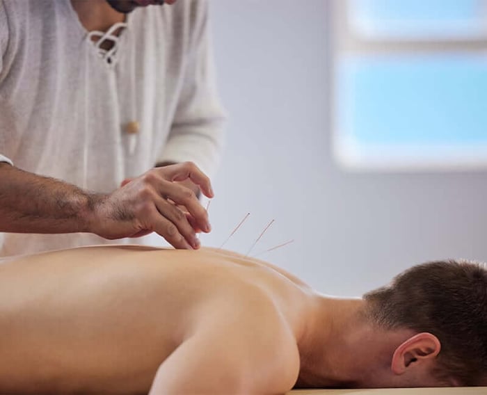 Acupuncture