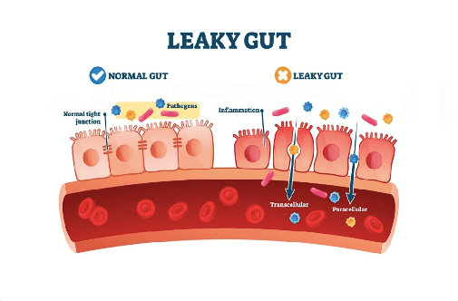 Leaky Gut is Common