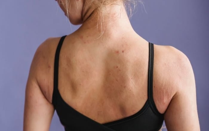 5 Tips to Consider When Buying Mastectomy Bras