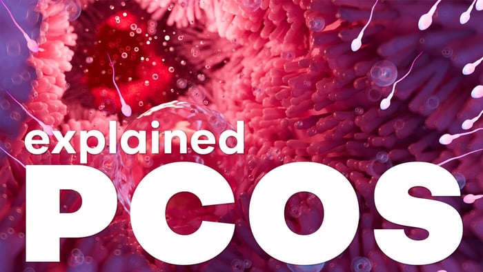 What is Polycystic Ovary Syndrome (PCOS)?