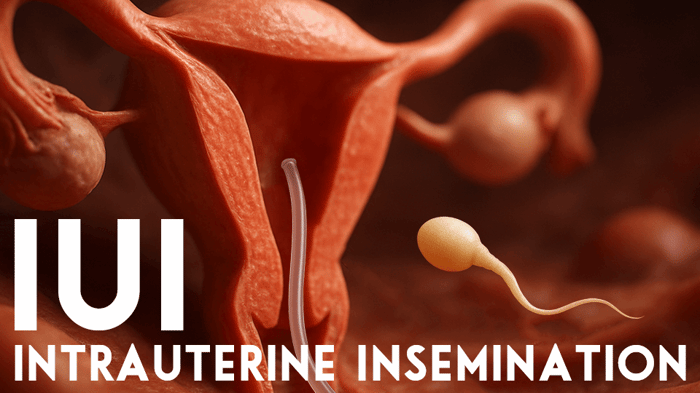 Illustration showing IUI intrauterine insemination procedure, featuring a catheter inserting sperm directly into the uterus