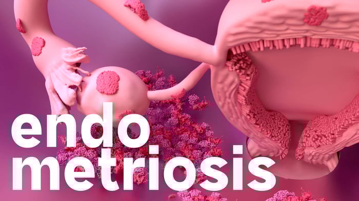 The Hidden Truth About Endometriosis