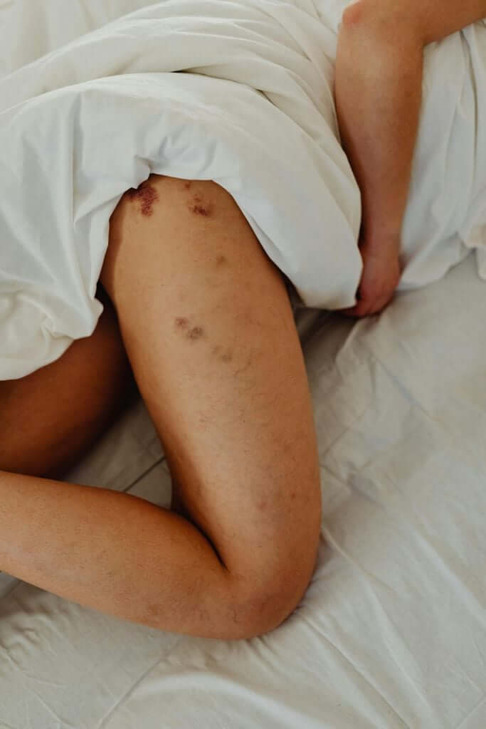 The Caregiver Guide – Managing Pressure Ulcers (Bedsores)