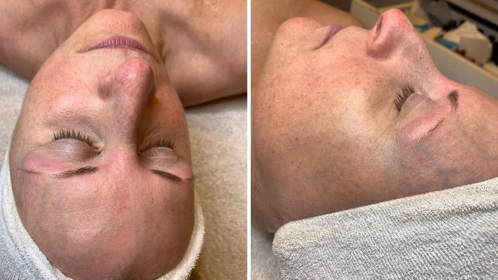 How to Dermaplane at Home