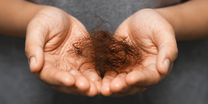 can an oily scalp cause hair loss?