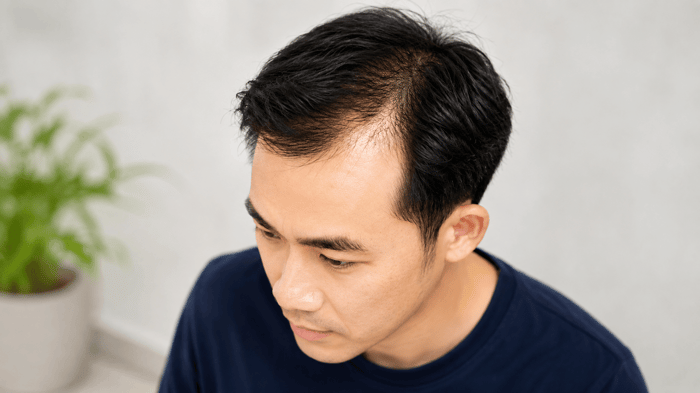 Male Pattern Hair Loss: What Men Need to Know