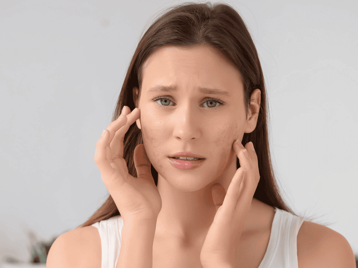 Skincare for Hyperpigmentation: Even-Tone Plan