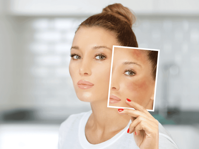 Skincare for Melasma: The Complete Strategy