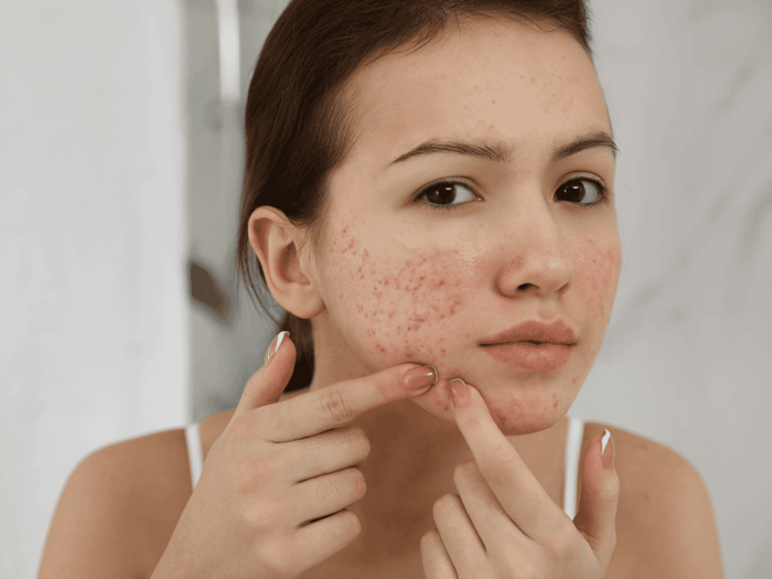 Skincare for Post-Acne Marks: Fade Them Smarter