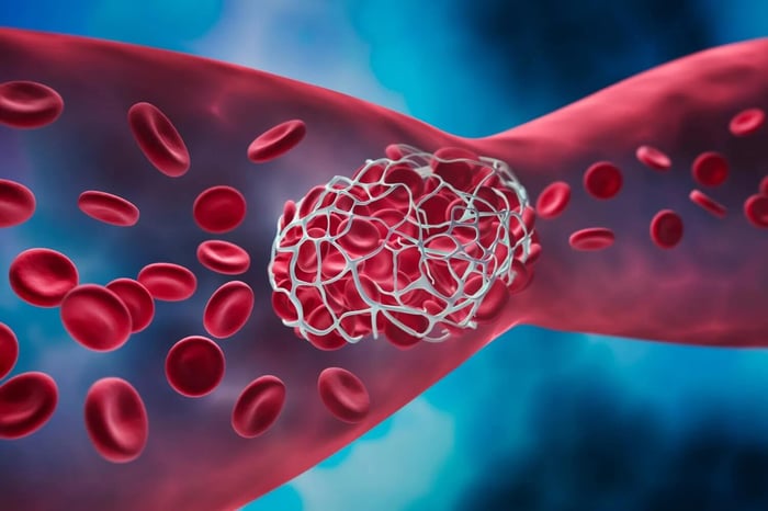 Blood clot blocking a blood vessel.