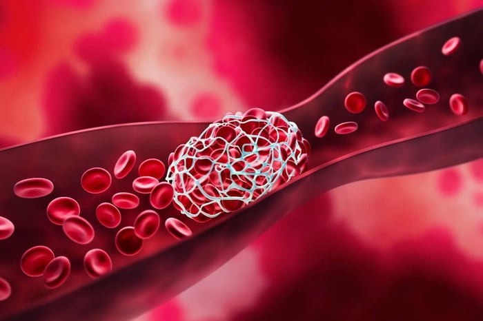 What Causes Blood Clots? The Risk Factors Most People Don't Know About