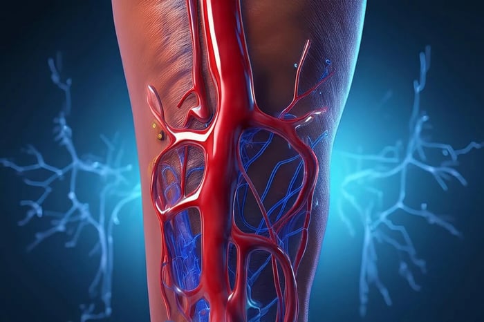 What Is DVT? Deep Vein Thrombosis Explained — Causes, Risks, and Prevention