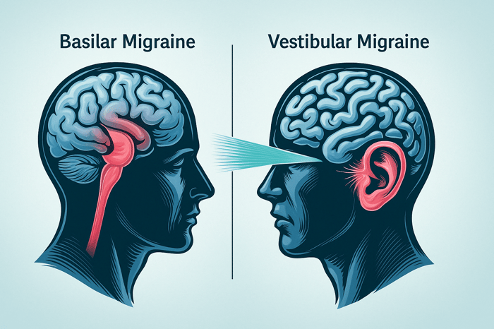 Alt text: Illustration of basilar migraine and vestibular migraine differences