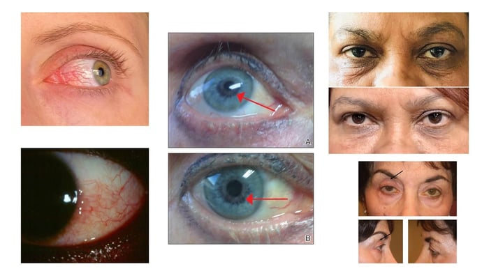 Hidden Dangers in Lash Serums: A Comprehensive Analysis of Prostaglandin Side Effects and Medical Warnings