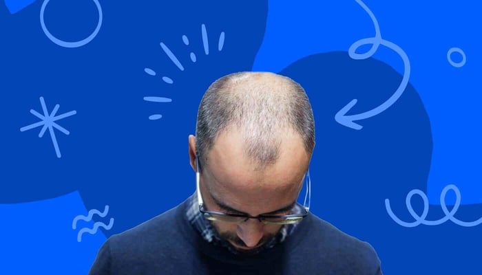 a man with hair loss