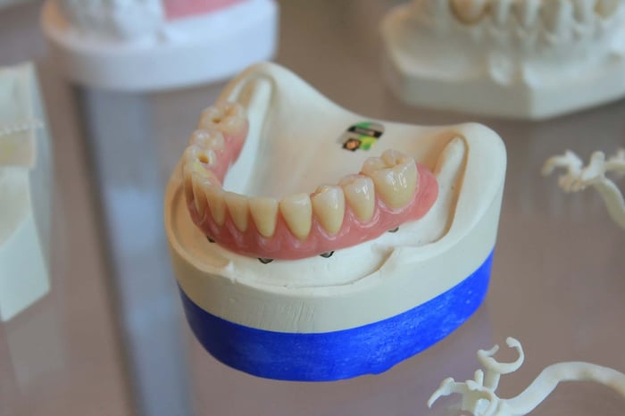 showing of dental crowns vs dental bridges