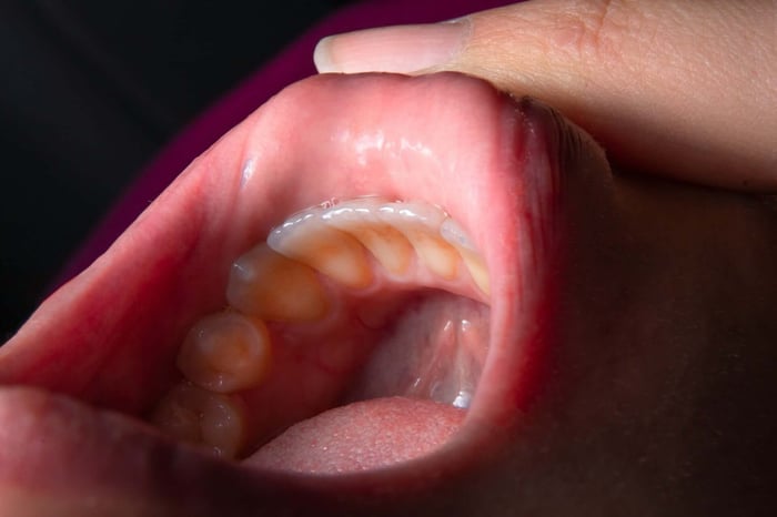 Gingivitis vs Gum Disease