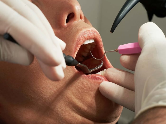 Dental Bonding vs Veneers for Everyday Smile Concerns