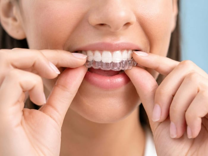 How Invisalign® Works Step by Step Before You Commit