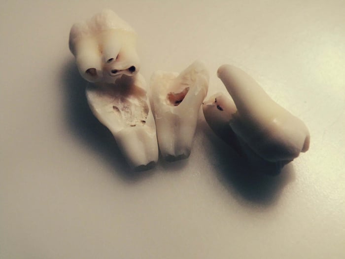 A couple of pieces of tooth