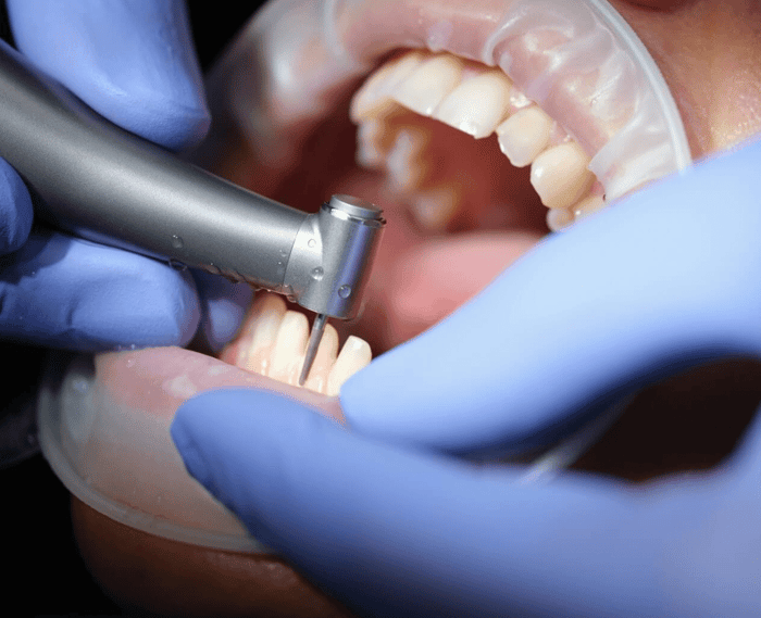 Dental Bonding vs Veneers
