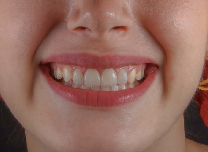 Foods and Drinks That Stain Your Teeth