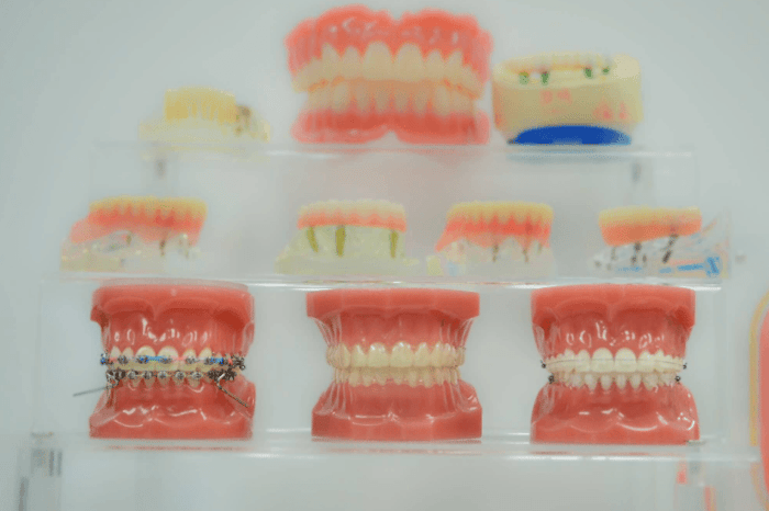 How Long Do Veneers Last vs Composite Bonding