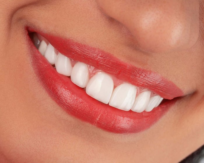 teeth whitening at the dentist vs store-bought kits
