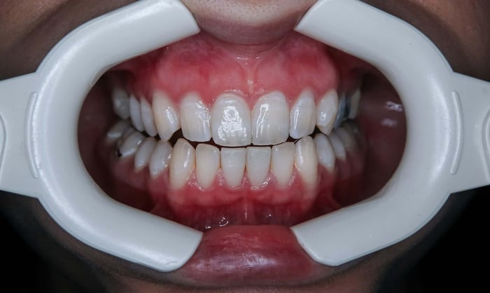 Composite bonding uses a tooth-colored resin that your dentist applies directly to the tooth