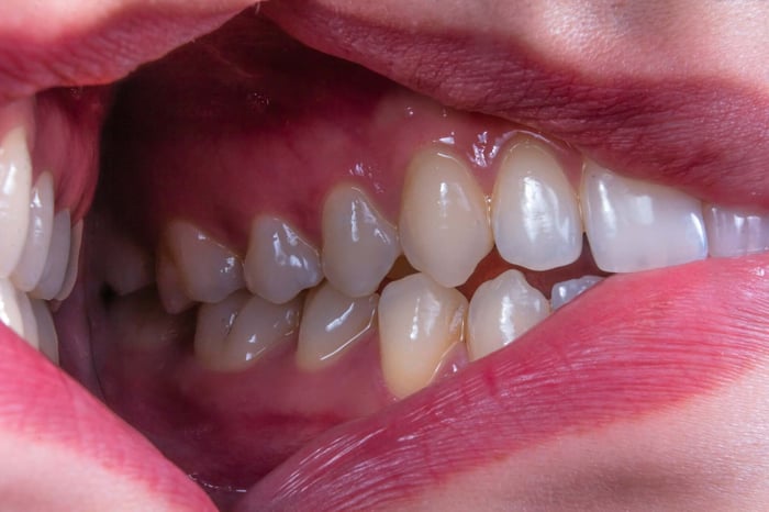 gums bleeding