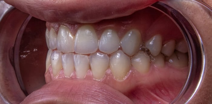 A close up photo of a person's teeth