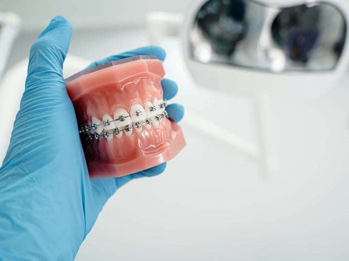 Metal Braces: Still a Trusted Choice for Straightening Your Smile