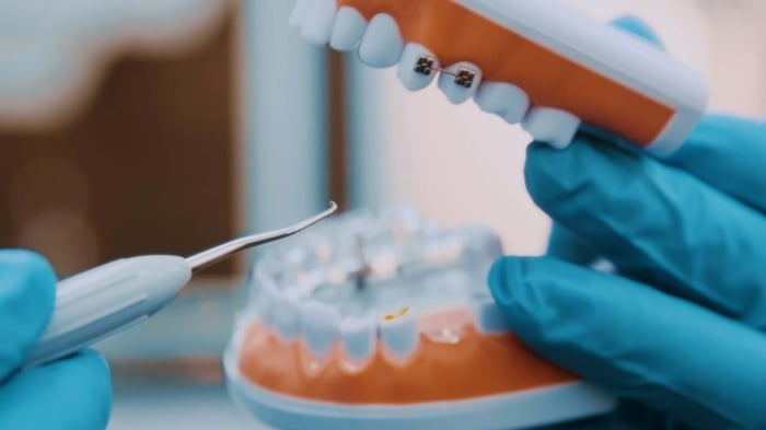 Metal Braces vs Clear Braces: Compare and Choose the Right Fit for You