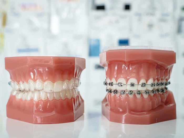 When Braces May Help Correct Bite or Spacing Concerns and Why It Matters