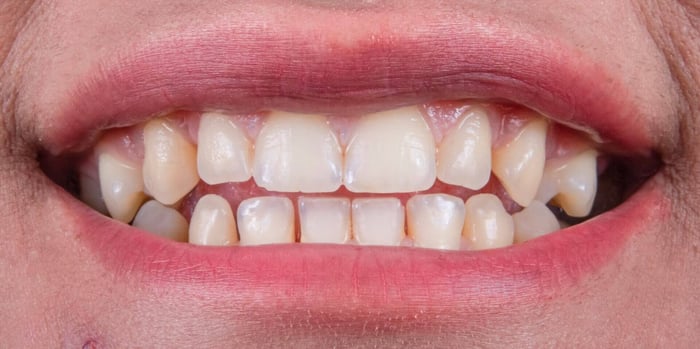 why dental crowns are used after chips