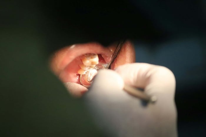 How Long Do Dental Fillings Last