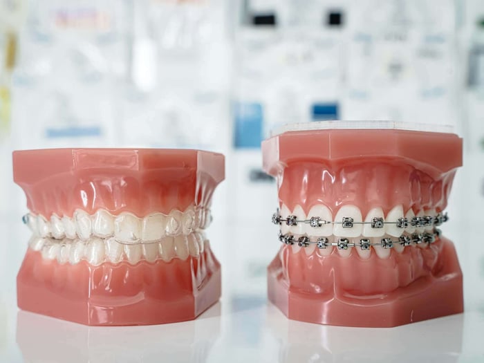 Invisalign vs Braces for Teenagers in Gardena