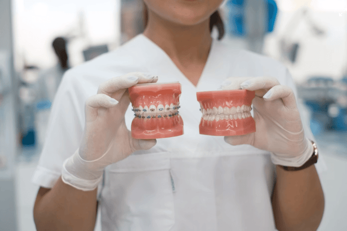Metal Braces vs Clear Aligners