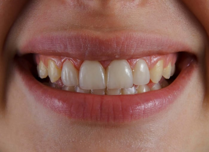Why Do My Gums Bleed When I Brush