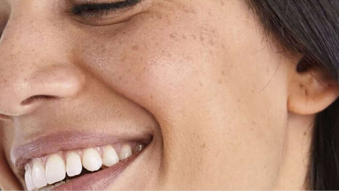 Close-up of a smiling woman's face showing natural skin with light freckles and sun spots from UV exposure