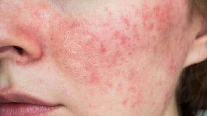 Close-up of woman's face showing red, inflamed rosacea symptoms across cheek and nose area
