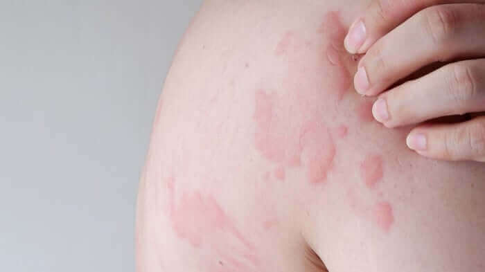 Close-up of skin showing red, raised hives and welts characteristic of chronic urticaria with hand touching affected area