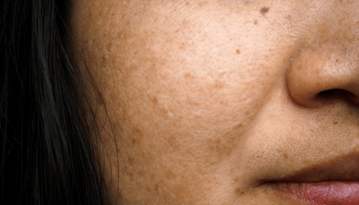 Close-up of woman's face showing melasma pigmentation patches on cheek and nose area